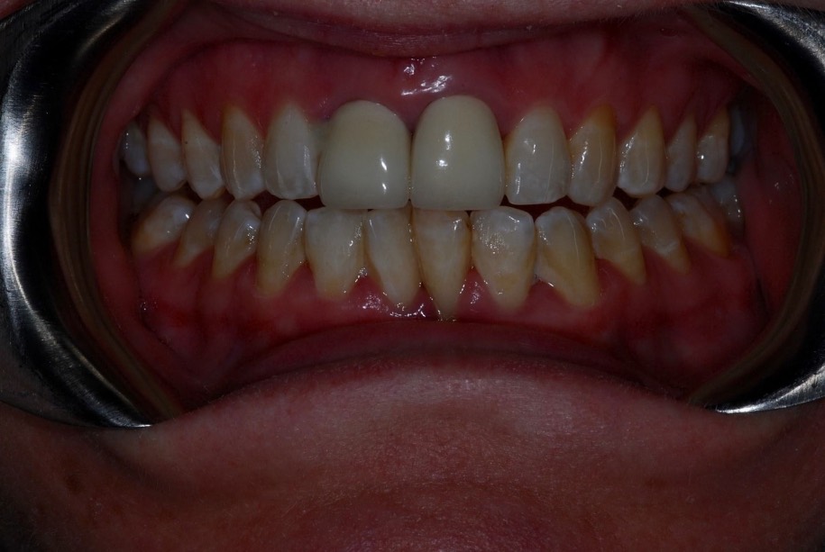 Inman aligner before, Wellington patient at Thorndon Dental