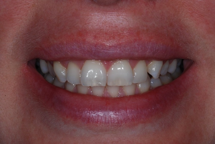 Inman aligner before, Wellington patient at Thorndon Dental