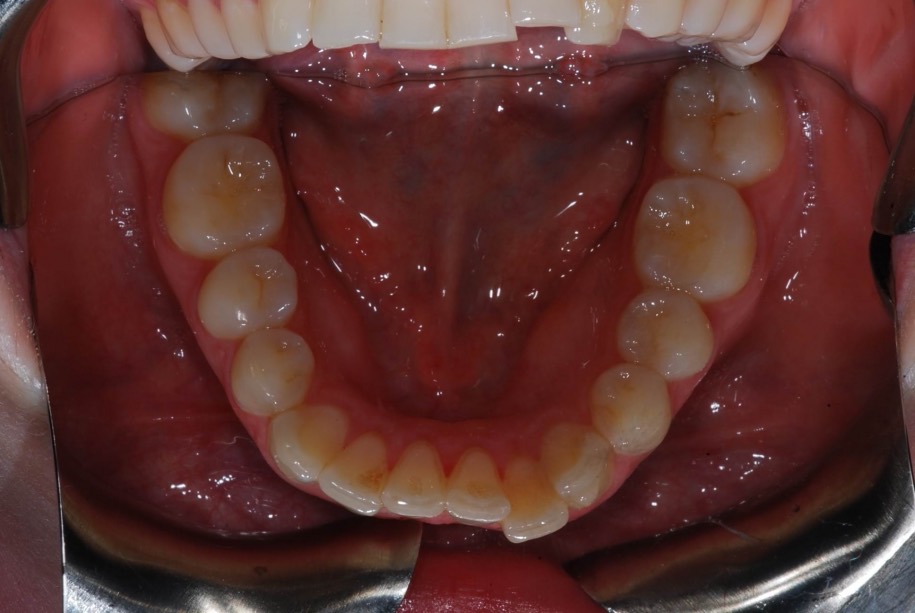 Invisalign before, Wellington patient at Thorndon Dental