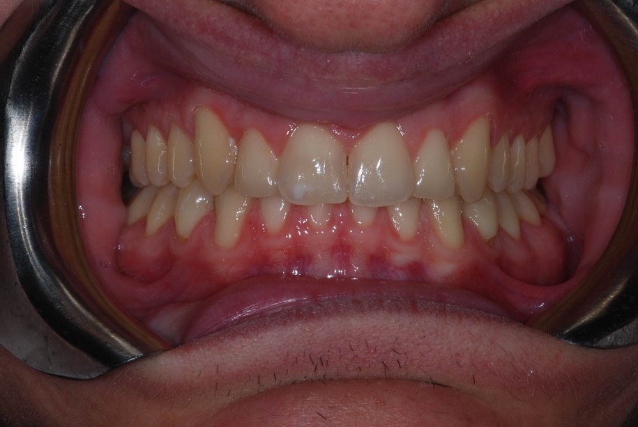 Invisalign after, Wellington patient at Thorndon Dental