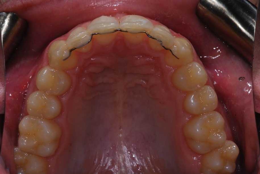 Invisalign after, Wellington patient at Thorndon Dental