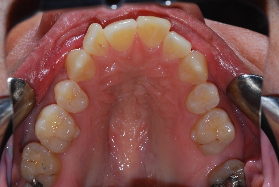 Invisalign before, Wellington patient at Thorndon Dental
