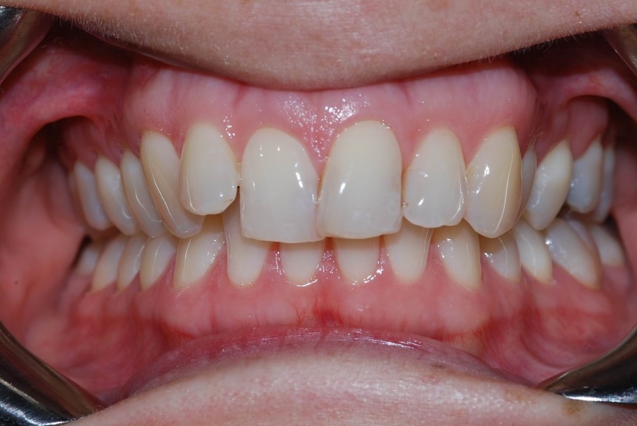 Invisalign before, Wellington patient at Thorndon Dental
