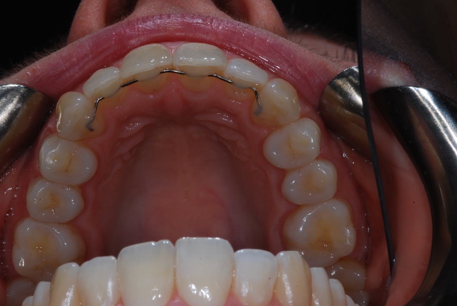 Invisalign after, Wellington patient at Thorndon Dental