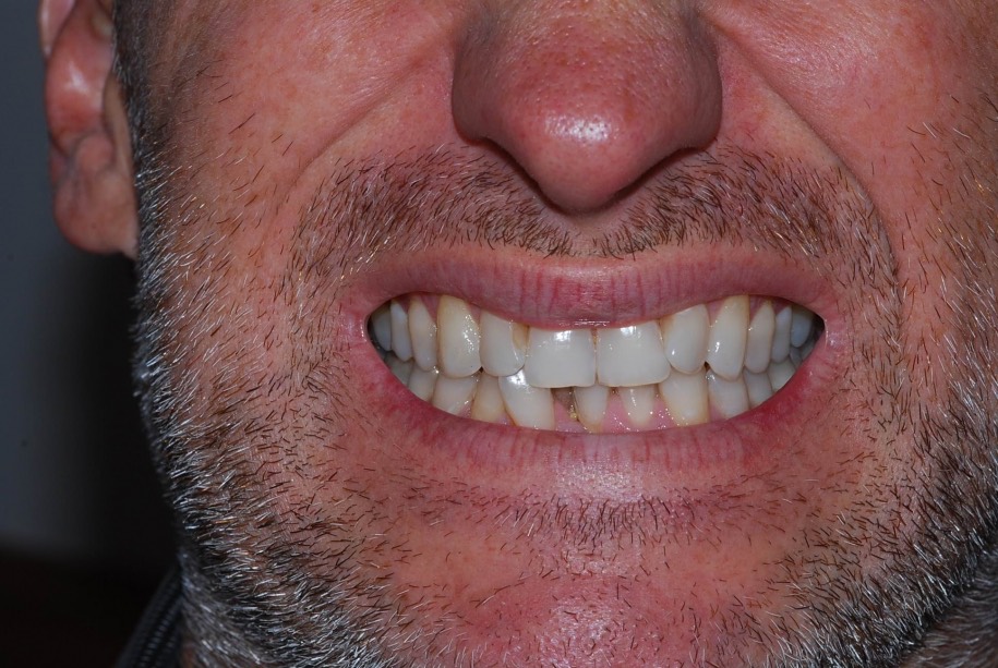 Invisalign before, Wellington patient at Thorndon Dental