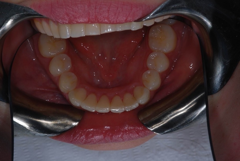 Invisalign after, Wellington patient at Thorndon Dental