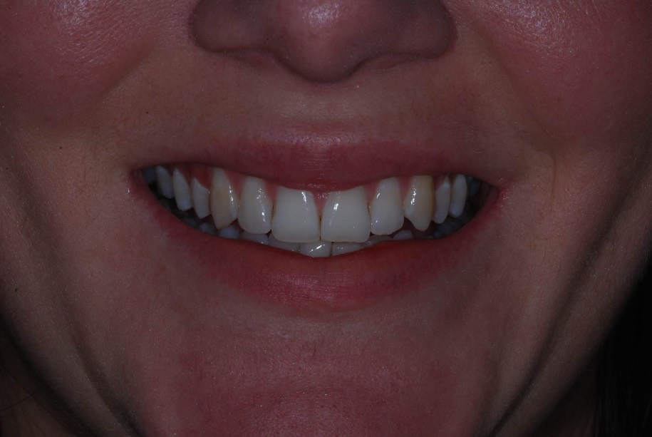 Invisalign after, Wellington patient at Thorndon Dental