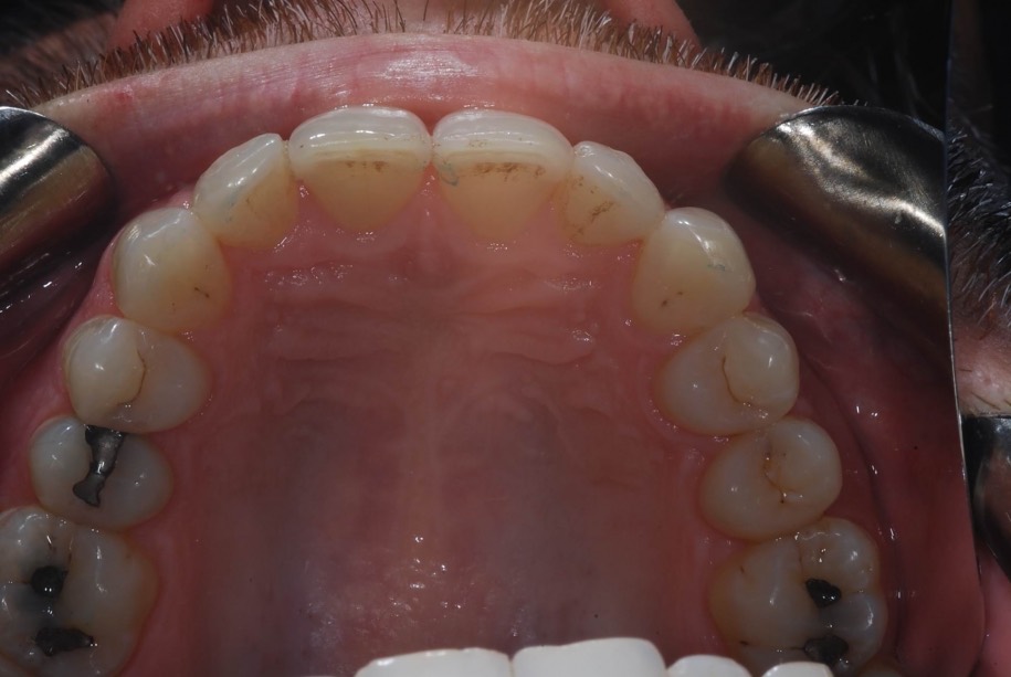 Invisalign after, Wellington patient at Thorndon Dental
