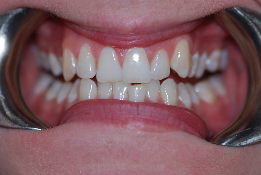Invisalign before, Wellington patient at Thorndon Dental
