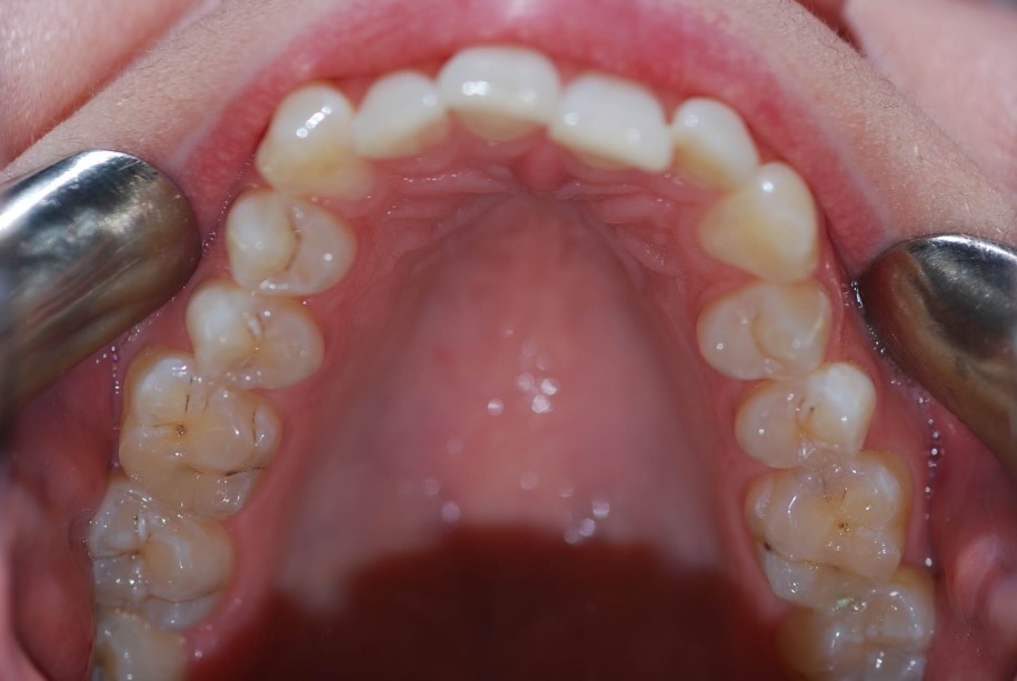 Invisalign before, Wellington patient at Thorndon Dental