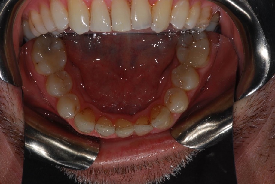 Invisalign after, Wellington patient at Thorndon Dental