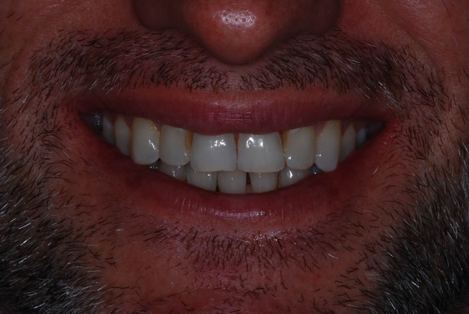 Invisalign after, Wellington patient at Thorndon Dental