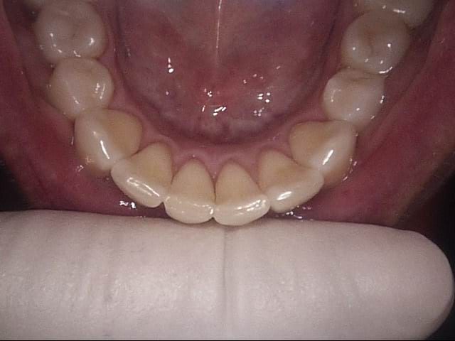 Invisalign after, Wellington patient at Thorndon Dental