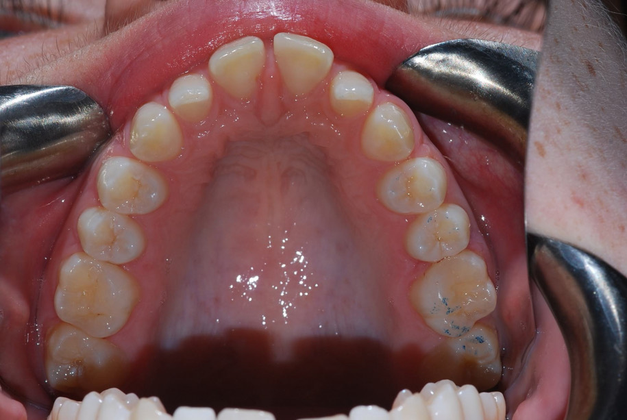 Invisalign before, Wellington patient at Thorndon Dental