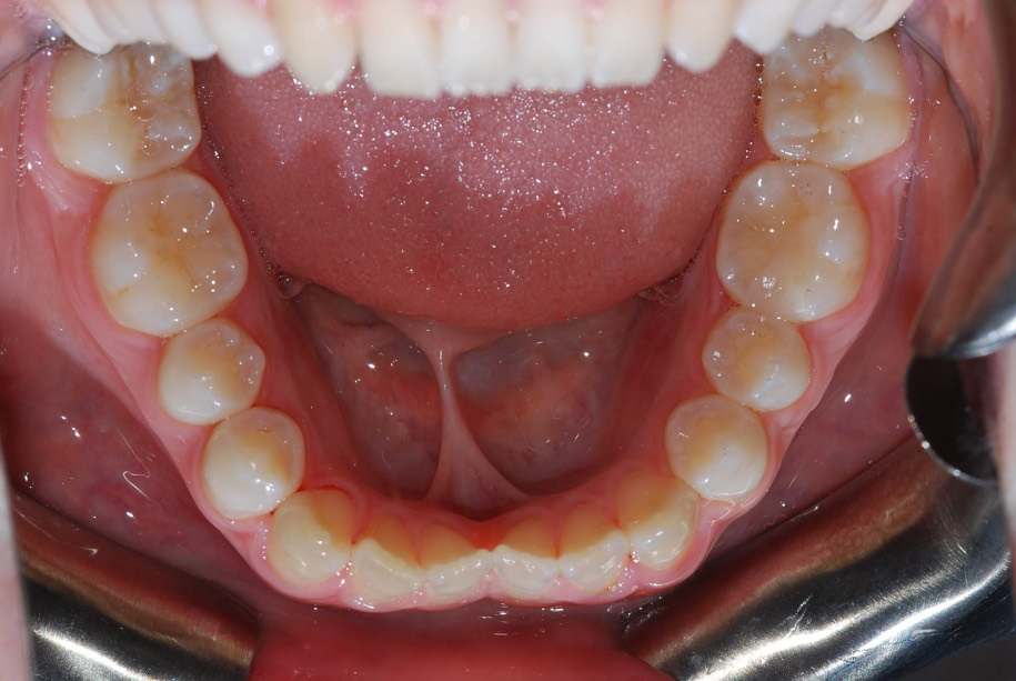 Invisalign before, Wellington patient at Thorndon Dental