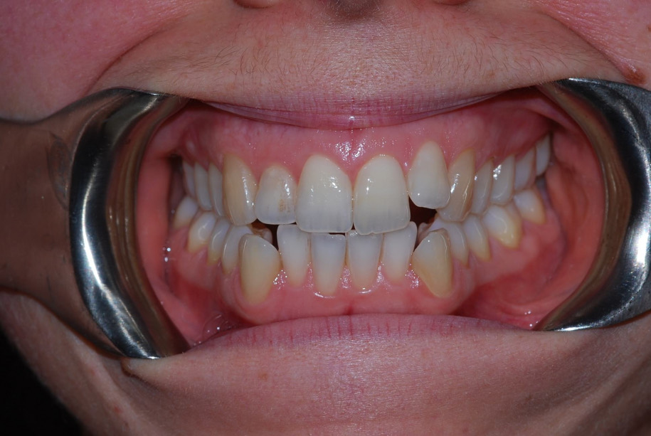 Invisalign before, Wellington patient at Thorndon Dental