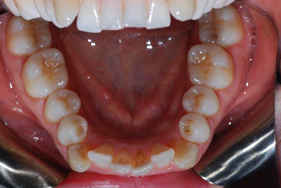 Invisalign before, Wellington patient at Thorndon Dental