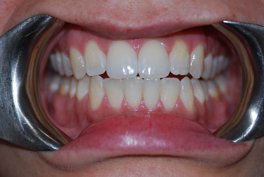 Invisalign after, Wellington patient at Thorndon Dental