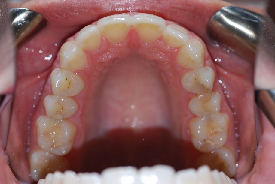 Invisalign after, Wellington patient at Thorndon Dental