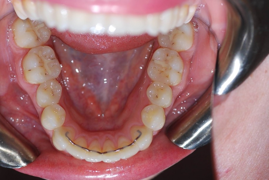 Invisalign after, Wellington patient at Thorndon Dental
