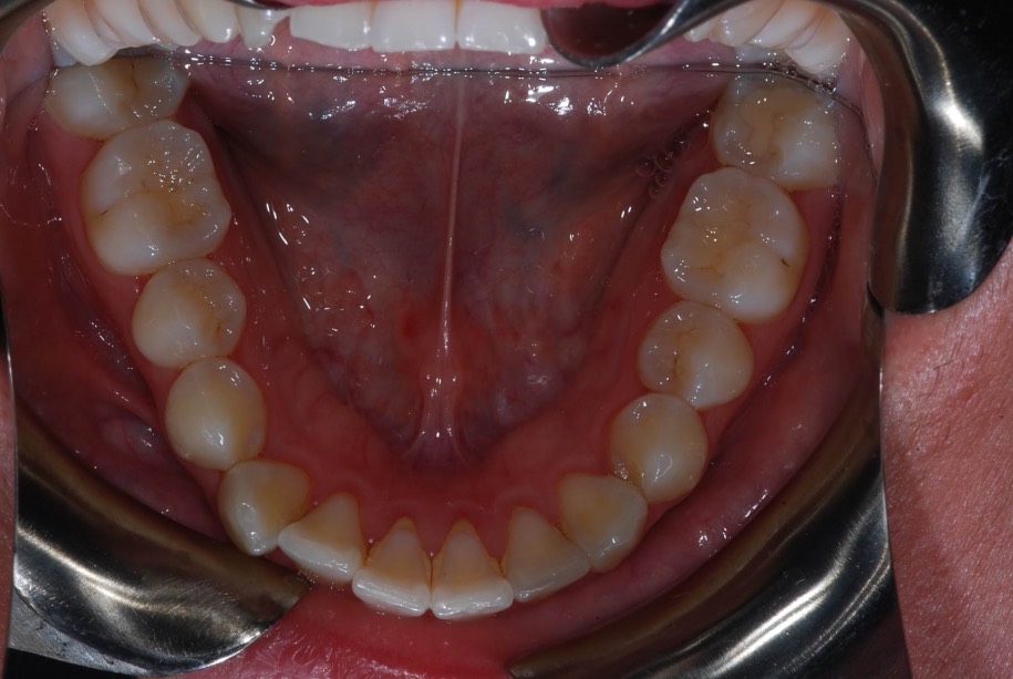 Invisalign before, Wellington patient at Thorndon Dental