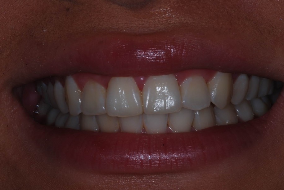 Invisalign after, Wellington patient at Thorndon Dental