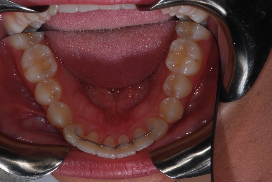 Invisalign after, Wellington patient at Thorndon Dental