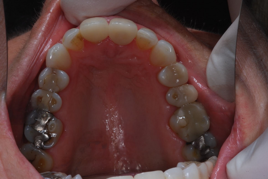 Invisalign after, Wellington patient at Thorndon Dental