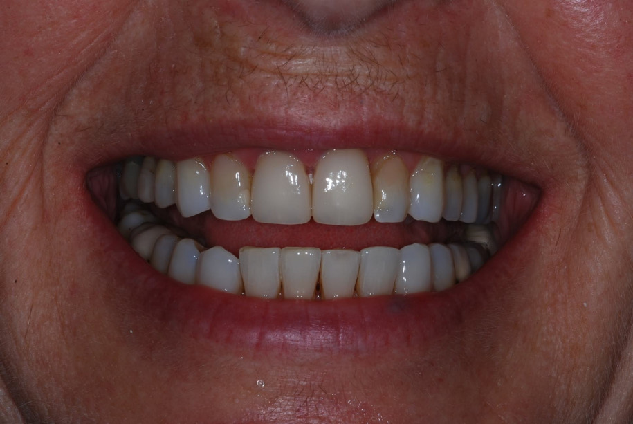Invisalign after, Wellington patient at Thorndon Dental