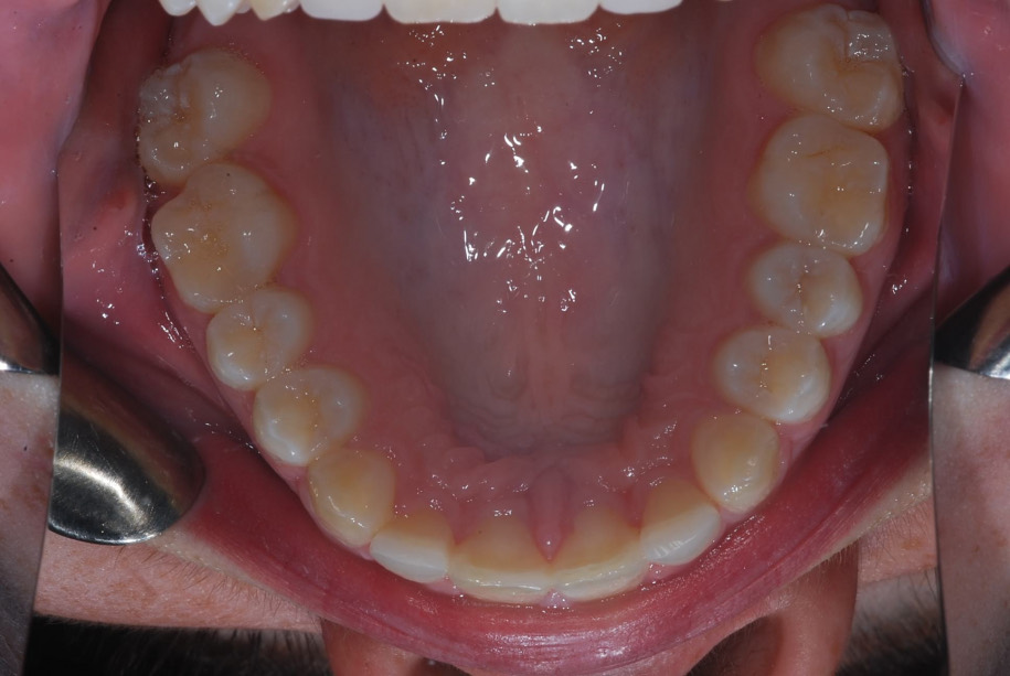 Invisalign after, Wellington patient at Thorndon Dental