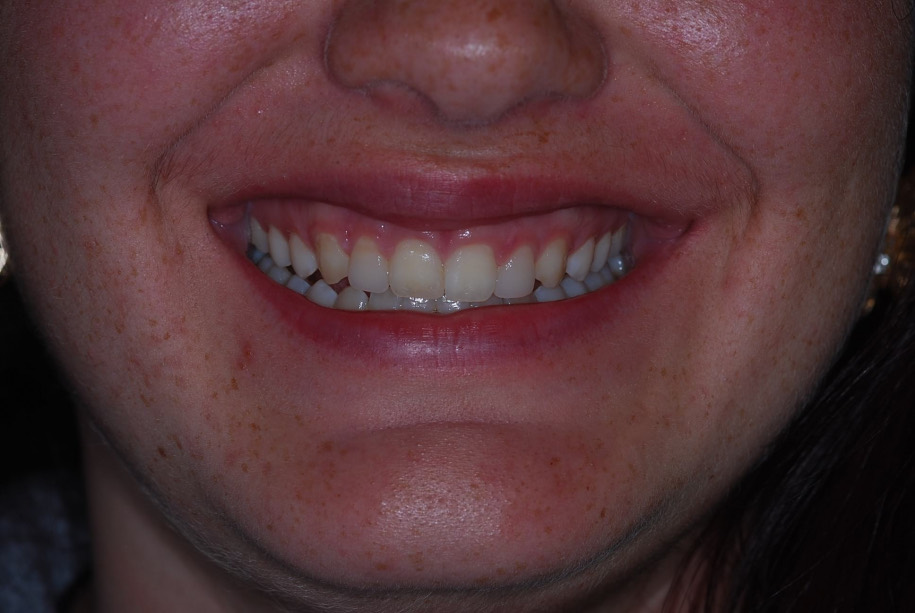 Invisalign after, Wellington patient at Thorndon Dental