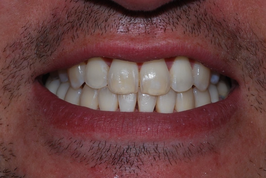 Invisalign after, Wellington patient at Thorndon Dental