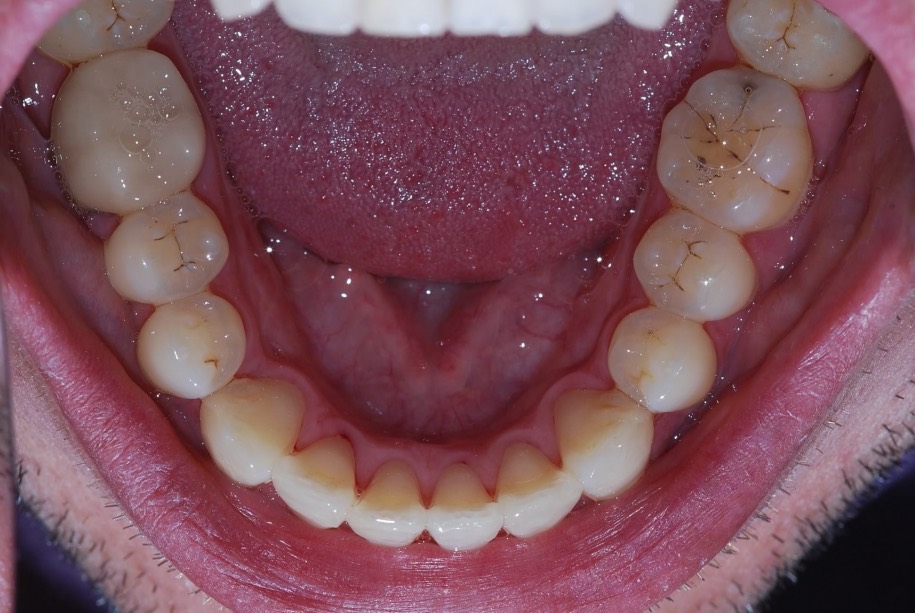Invisalign after, Wellington patient at Thorndon Dental
