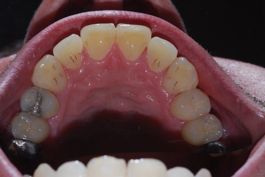 Invisalign after, Wellington patient at Thorndon Dental