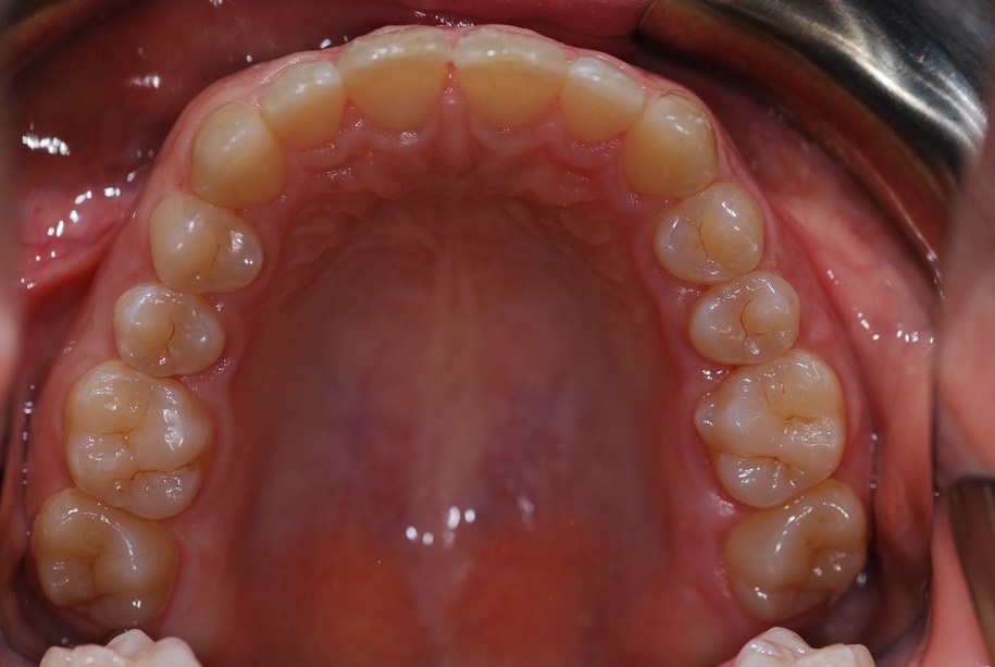 Invisalign after, Wellington patient at Thorndon Dental