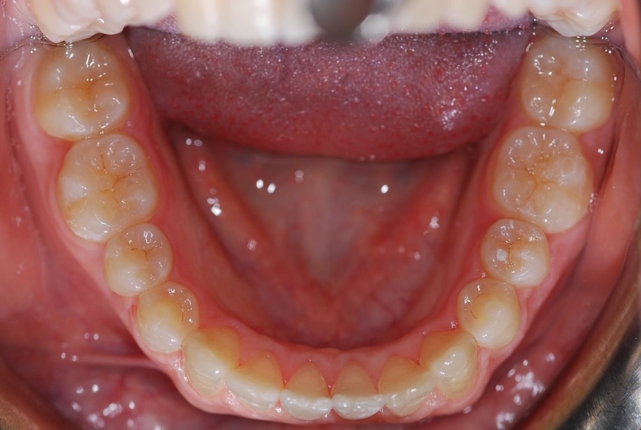 Invisalign after, Wellington patient at Thorndon Dental