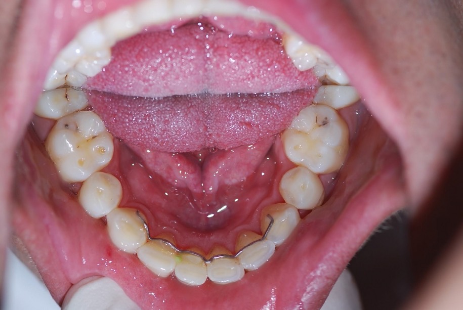 Invisalign after, Wellington patient at Thorndon Dental