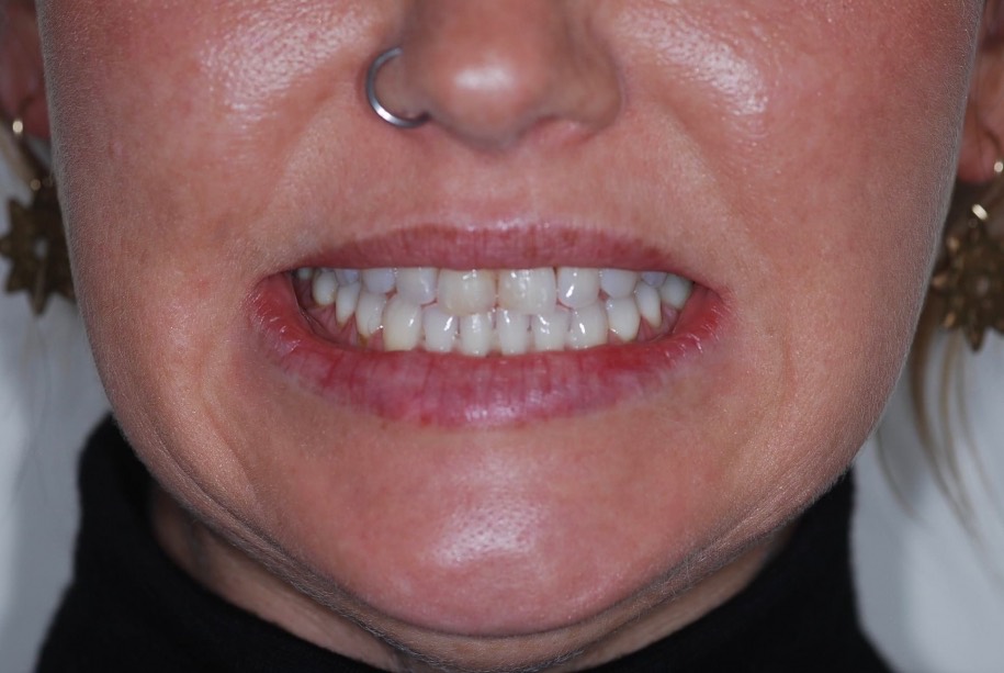 Invisalign after, Wellington patient at Thorndon Dental