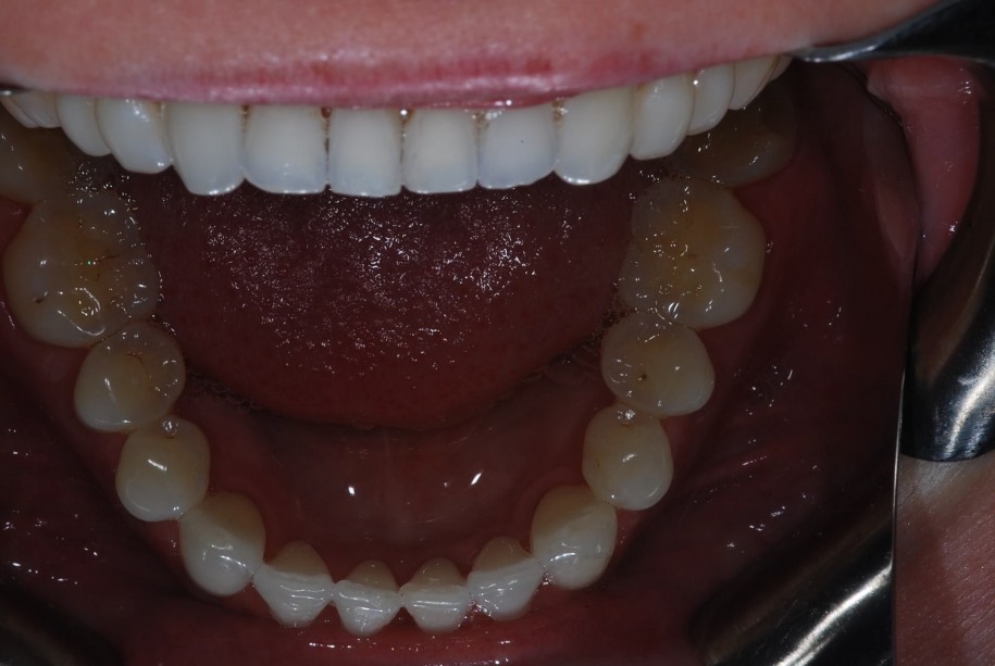Invisalign after, Wellington patient at Thorndon Dental