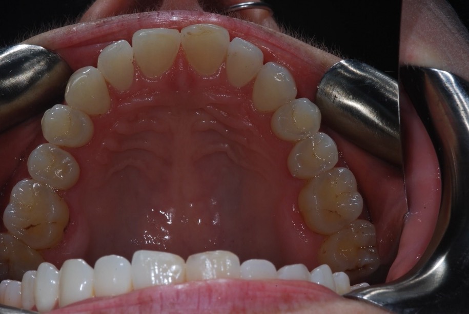 Invisalign after, Wellington patient at Thorndon Dental