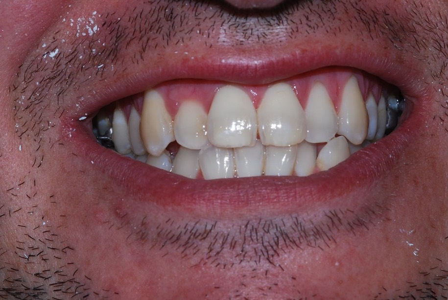 Invisalign before, Wellington patient at Thorndon Dental