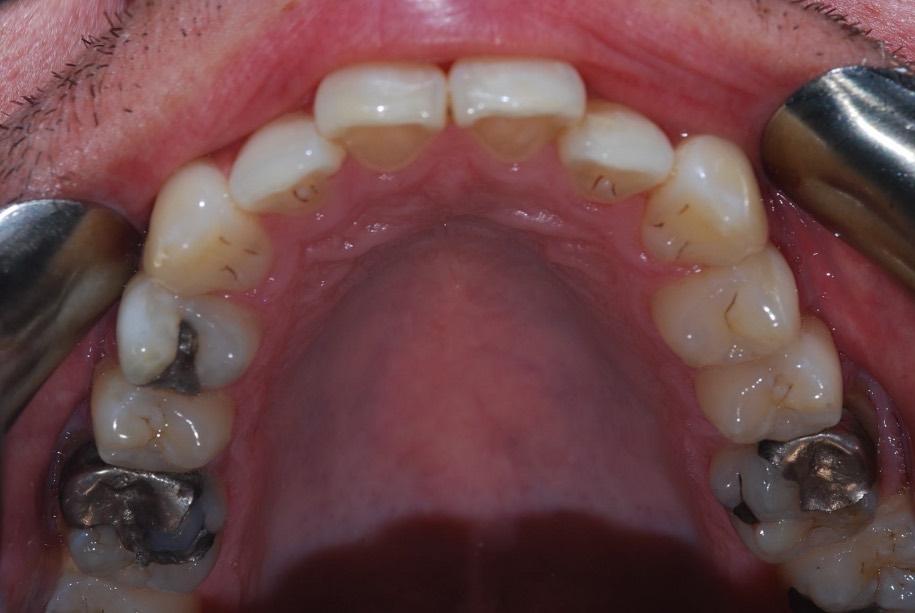 Invisalign before, Wellington patient at Thorndon Dental