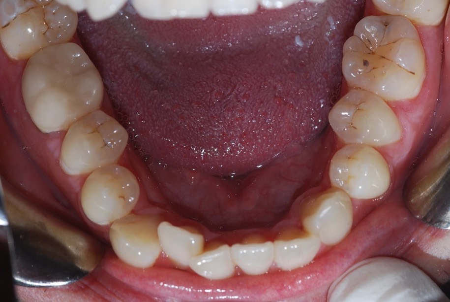 Invisalign before, Wellington patient at Thorndon Dental