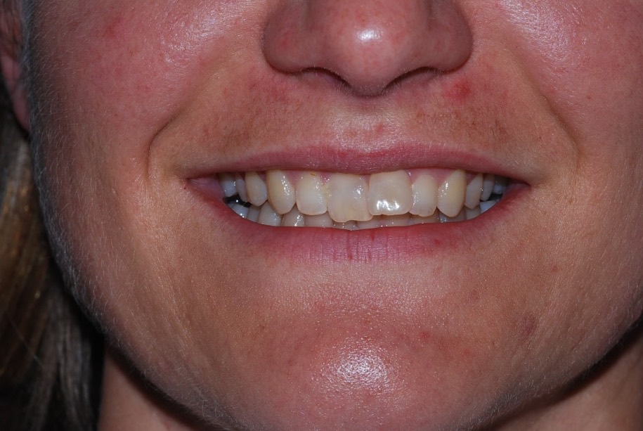 Invisalign before, Wellington patient at Thorndon Dental