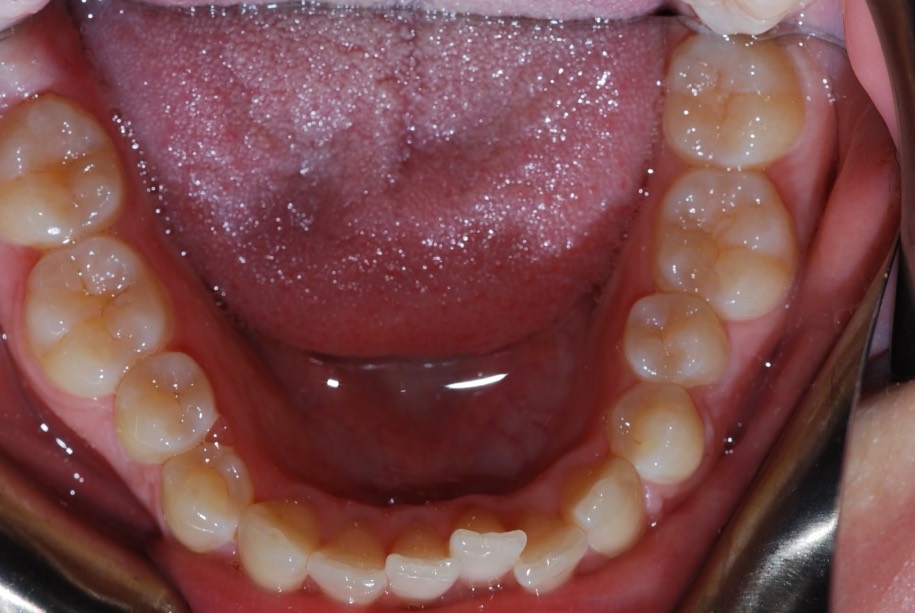 Invisalign before, Wellington patient at Thorndon Dental