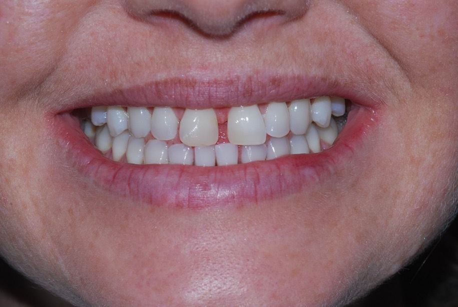 Invisalign before, Wellington patient at Thorndon Dental