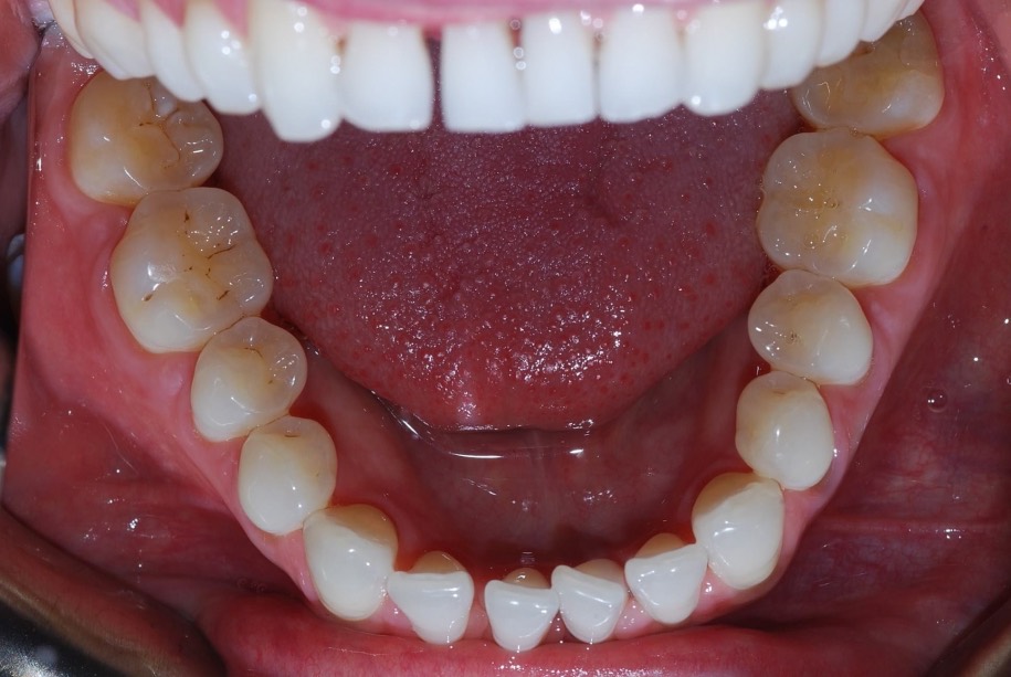 Invisalign before, Wellington patient at Thorndon Dental