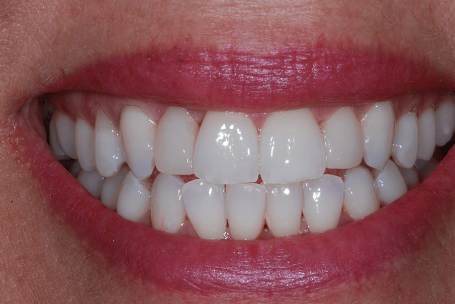 Teeth whitening after, Wellington patient at Thorndon Dental