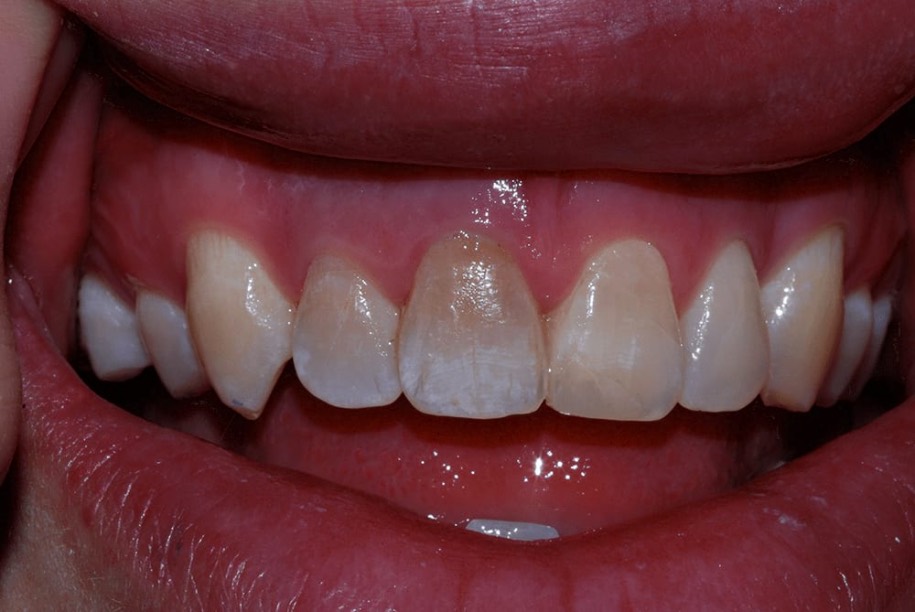 Teeth whitening after, Wellington patient at Thorndon Dental