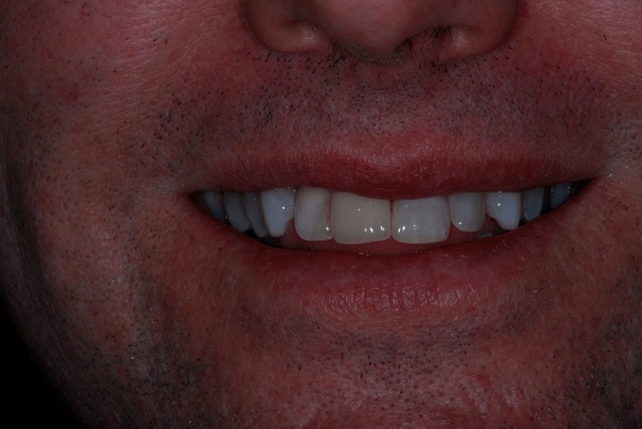 Teeth whitening after, Wellington patient at Thorndon Dental